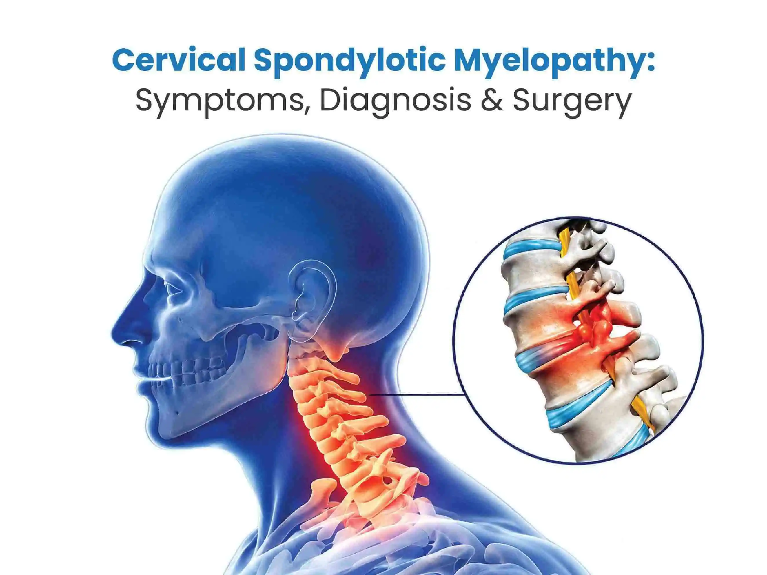 Cervical Spondylotic Myelopathy: Symptoms, Diagnosis & Surgery